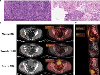 RNA Sequencing for Personalized Treatment of Metastatic Leiomyosarcoma: Case Report